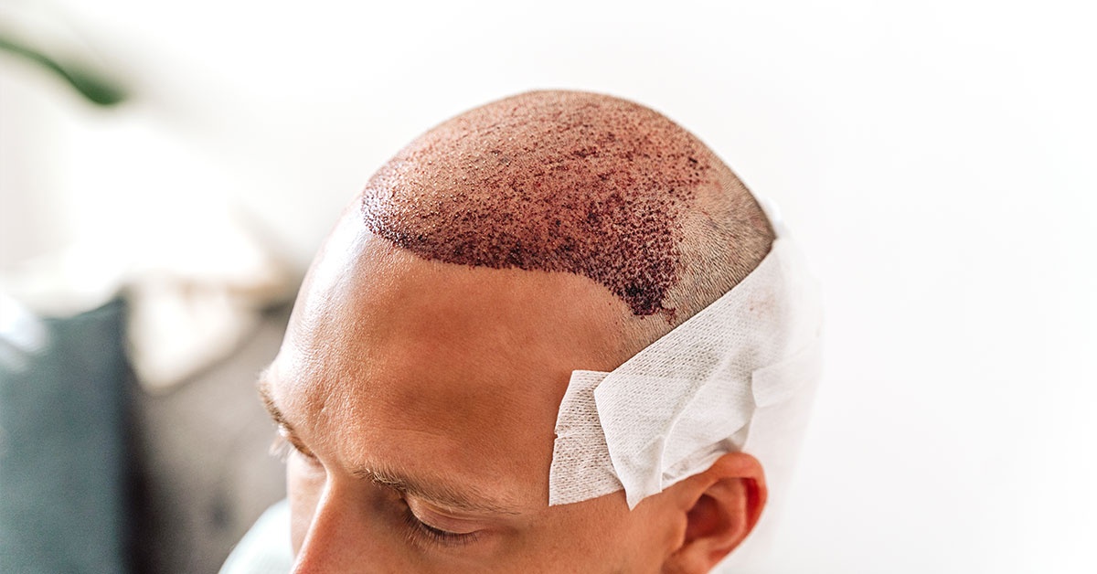 hair transplant Manchester