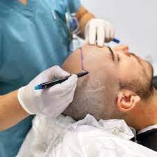 hair transplant clinic in pune
